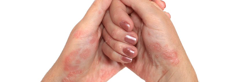 Von allen inflammatorisch bedingten Hautläsionen schränkt die palmoplantare Pustulose die Lebensqualität am meisten ein.