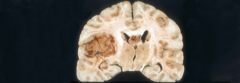 Glioblastome sind die häufigsten primären Hirntumoren. Das progessionsfreie Überleben liegt bei median ca. einem halben Jahr, das Gesamtüberleben etwa eineinhalb Jahren.