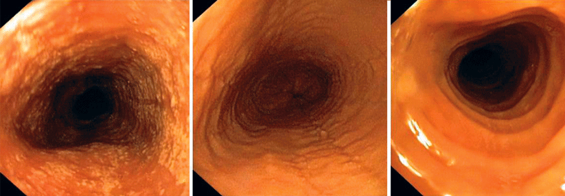 Leidet ein Patient mit Asthma oder allergischer Rhinitis unter Schluckstörungen, liegt der Verdacht auf eine eosinophile Ösophagitis nahe. Die Endoskopie sorgt für Gewissheit: Typische Befunde sind weiße Exsudate (links), Längsfurchen (Mitte) oder eine Trachealisierung der Speiseröhre (rechts).