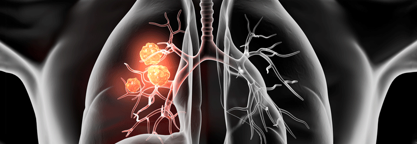 Bei Lungenkrebs treten die ersten Symptome meist erst dann auf, wenn sich bereits Metastasen gebildet haben. 