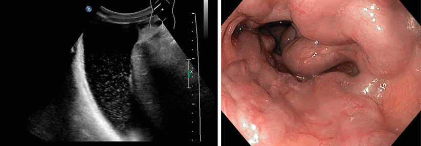 Wandern aufgrund der portalen Hypertension Bakterien vom Darm in den Aszites, droht eine Bauchfellentzündung (links). Ösophagusvarizen so lange endoskopisch behandeln, bis keine mehr zu sehen sind (rechts).