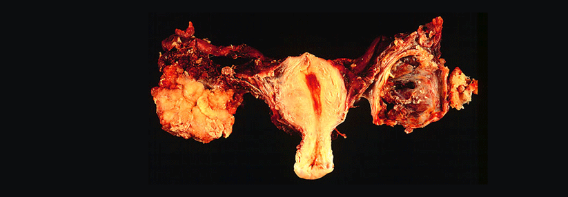 Dieses beidseitige Ovarialkarzinom wurde bei einer Laparotomie entdeckt.