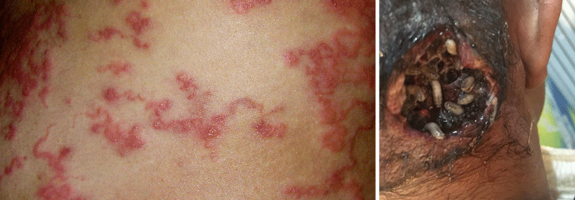 Bei einem schweren Befall mit Larva migrans sieht man die Kontur der Larven durch die Haut hindruch (links). Darüber hinaus kann die Myia­sis noch viel schlimmere Ausmaße annehmen (rechts).