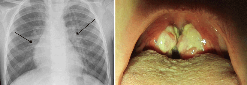 Eine RSV-Infektion lässt sich an der typischen perihilären Zeichnungs­vermehrung (Pfeile) erkennen (links). Hyperplastische Tonsillen mit Fibrinbelägen: Sieht der Rachen so aus, liegt eine EBV-Infektion nahe (rechts).