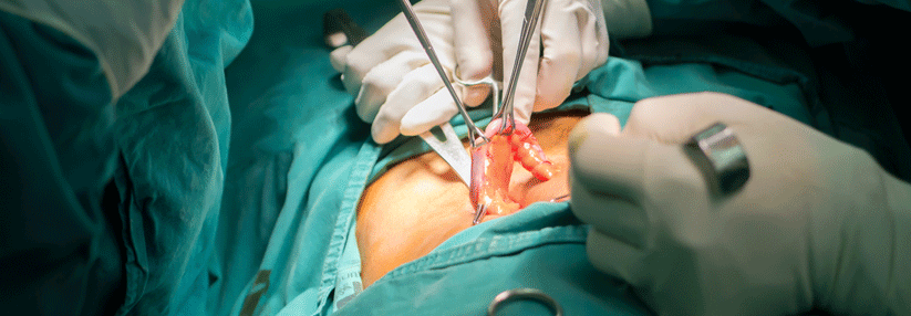 Der eitrige Appendix wäre ohne die Operation sicherlich bald perforiert.