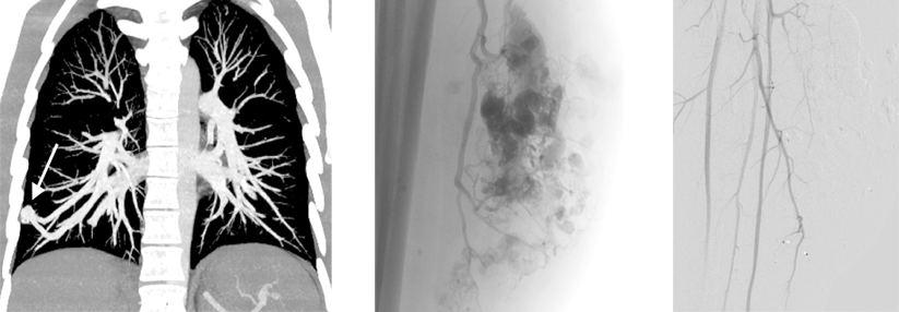 Ein 55-Jähriger mit pulmonalen arteriovenösen Fisteln (s. Pfeil, links) wurde mit „Stöpseln“ aus Nitinol-Draht behandelt, die arteriovenöse Malformation in der Wade eines 58-Jährigen (rechts) mittels Flüssigembolisat.