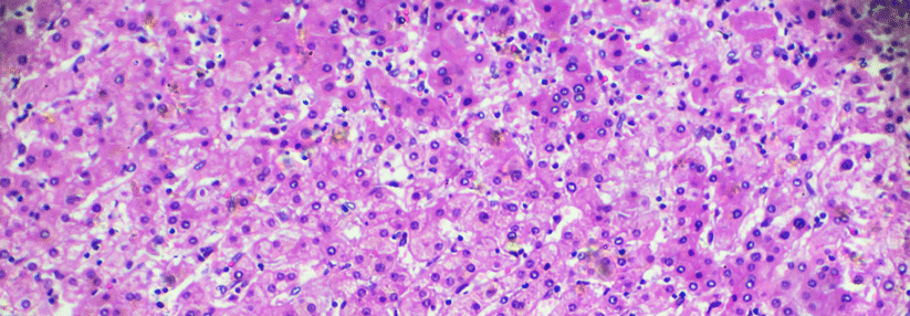 Cabozantinib hat sich beim metastasierten Nierenzellkarzinom bereits als erfolgreich erwiesen und jetzt auch beim hepatozellulären Karzinom (HCC) eine hohe Effektivität gezeigt.