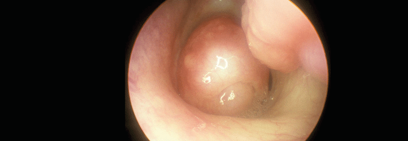 Fast jeder zweite Patient mit schwerem Asthma entwickelt nasale Polypen.