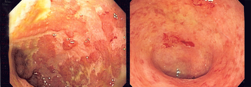 Dem endzündlichen Befall des Dickdarms könnte zukünftig der Toll-like-Rezeptor-Agonist Cobitolimod auf die Pelle rücken.