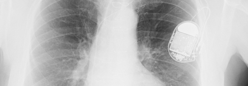 Mit einem implantierbaren Defi sinkt die Gefahr eines plötzlichen Herztods deutlich.
