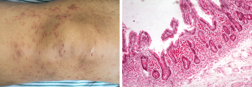 Neben den typischen Hauterkrankungen gibt es bei den Dermatologen auch seltenere Diagnosen wie eine Mycosis fungoides (links) oder einen kutanen Morbus Whipple (rechts).