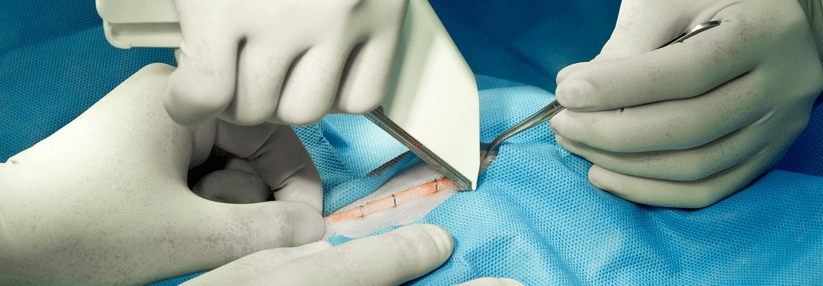 Falsch angebracht sorgen die Klammern der Stapler-Geräte für postoperative Komplikationen.