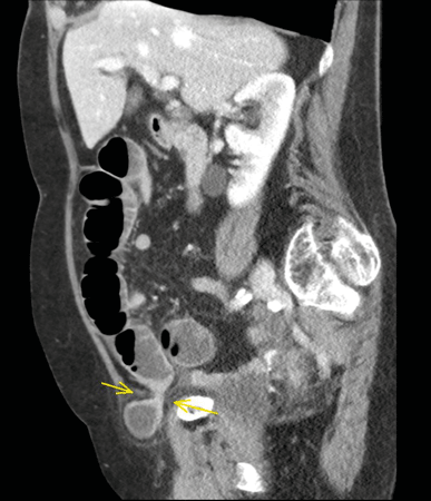 Typisches CT einer inkarzerierten Leistenhernie (Pfeil). Die Einklemmung hat schon zu einem Ileus (Spiegelbildung) geführt.