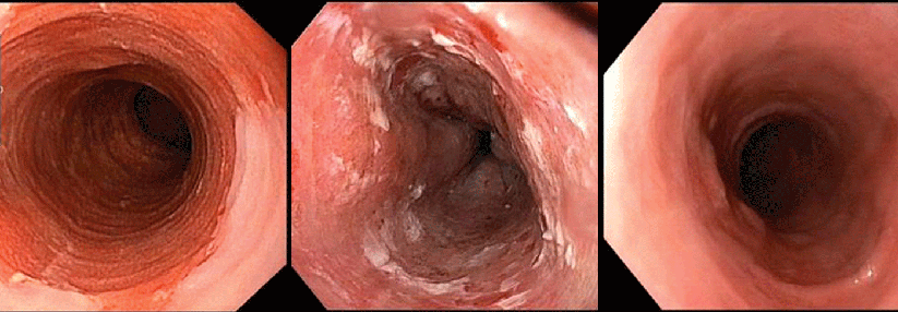 Ablation eines zirkulären Barrett-Ösophagus (Prag-Klassifikation C11, M1): vor Ablation (links) unmittelbar nach der zirkulären Radiofrequenzablation (Mitte) und drei Monate nach Ablation mit stattgehabter Reepithelialisierung (rechts).