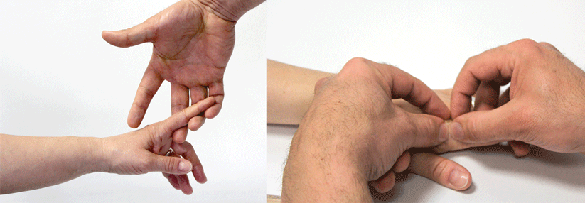 Bei der dorsalen Vier-Finger-Technik hebt der Untersucher mit drei Fingern den zu untersuchenden Finger des Patienten an. Der freie Daumen und der Zeigfinger palpieren das MCP-Gelenk von distal. Daumen und Zeigefinger der anderen Hand tasten von proximal, sodass das Gelenk mit vier Ärztefingern vom Handrücken aus untersucht wird.
