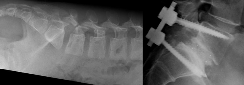 Spondylolysen entwickeln sich teils schon im Alter von elf Jahren (links). Hilft die konservative Therapie nicht, muss operativ unterstützt werden (rechts).