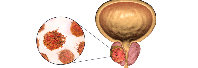 Die bipolare Androgen-Therapie scheint eine sichere Methode zur Remission eines CRPC zu sein.