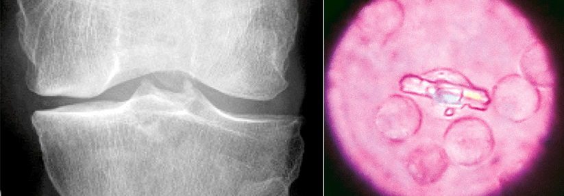 Alles deutete anfänglich auf eine rheumatoide Arthritis hin.