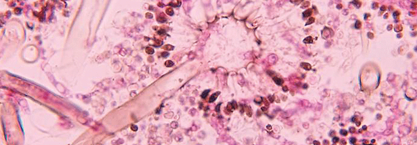 Im Schleim der Bronchiektasen gedeiht neben Bakterien auch der Gießkannenschimmel prächtig. 