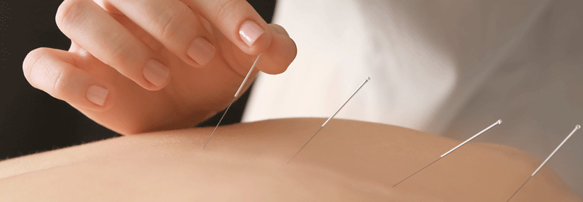 Den Schweiß einfach wegnadeln – mit Akupunktur lassen sich die vasomotorischen Symptome ganz leicht angehen.