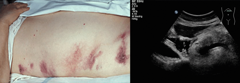 Zu den Symptomen der Pankreatitis gehören auch Einblutungen in den Flanken - das sogenannte Grey-Turner-Zeichen(links).