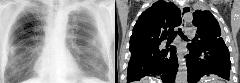 Folgen einer langjährigen Asbestexposition bei einem 72-jährigen ehemaligen Feuerungsmaurer: Das hochauflösende Low-Dose-Volumen-CT zeigt teilweise verkalkte breitbasige Plaques, die sich im konventionellen Röntgenbild nicht eindeutig identifizieren lassen – ein klarer Vorteil der CT.