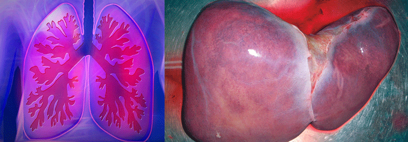 Das HPS gilt als Ausnahmegrund für die Listung zur Transplantation.