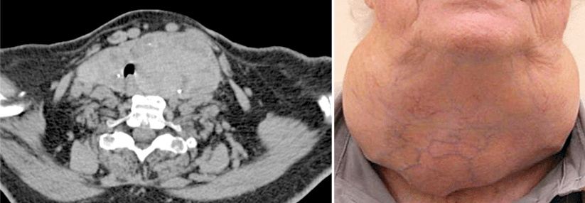 Dieses 300 ml große asymmetrische Organ (links) hat bereits die Trachea verschoben. Das Vollbild einer Struma nodosa – im wahrsten Sinne des Wortes (rechts).