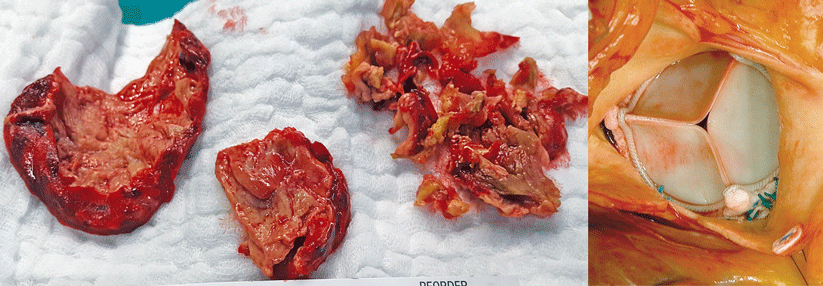 Mehr als nur ein Klappenbefall: Dieser Endokarditispatient hatte ausgeprägte Auflagerungen im linken Vorhof (links).  Sogar diese schwer geschädigte Mitralklappe ließ sich ohne kompletten Ersatz rekonstruieren (rechts) .