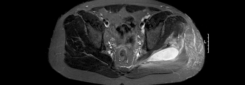 Die Risikofaktoren einer Pyomyositis sind intensive Aktivität, leichte Traumata und Hauterkrankungen.