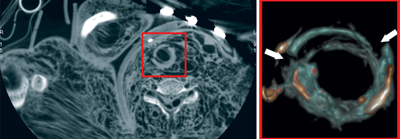 Was dieser 27-jährigen Frau widerfahren ist, verdeutlicht der transversale CT-Schnitt und die Rekonstruktion des Ringknorpels (vergrößerter Ausschnitt). Eine Strangulation hat das Krikoid verletzt (Pfeile).