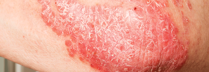 Die Psoriasis-Therapie gelingt nicht immer nach Schema F.