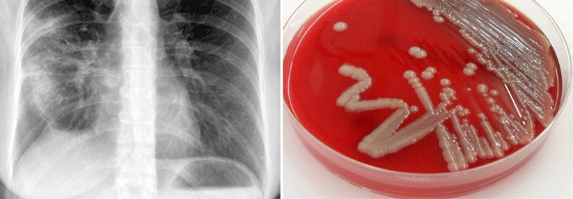In 8 % der Fälle geht die ambulant behandelte Pneumonie doch stationär (links). Manchmal entdeckt man bei Herzkranken  Klebsiellen (rechts).