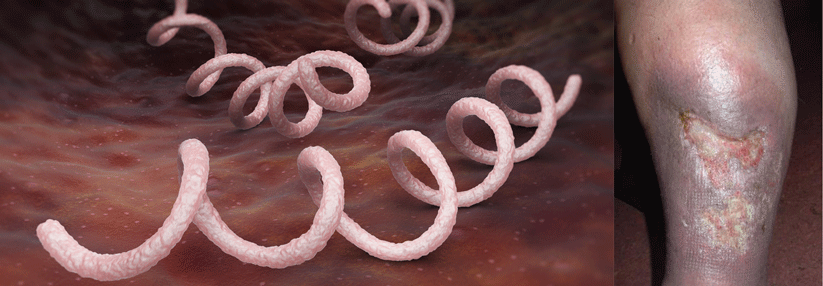 Zunehmend muss man auch bakteriell induzierte Ulzera infolge einer Syphilis in Betracht ziehen.