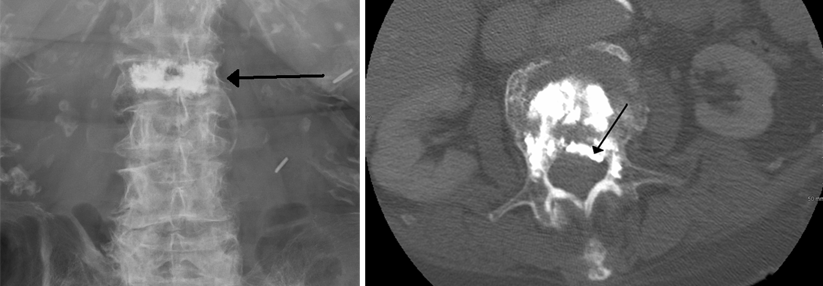 Das Zement im Knochen soll für Stabilität sorgen (links). Tritt es jedoch in den Spinalkanal ein und drückt es auf das Rückenmark kommt es zu neurologischen Symptomen (rechts).