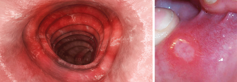 Anzeichen der Colitis Ulcerosa finden sich nicht nur im Darm (links). Die Patienten können gelegentlich Geschwüre an Zunge, Lippen, Gaumen oder Rachen aufweisen (rechts).