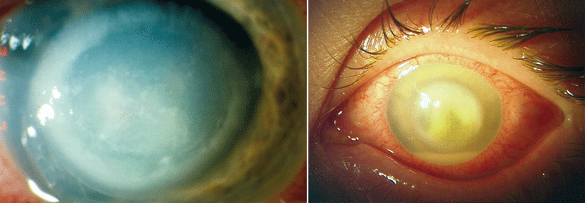 Das eitrige pseudomonadenbedingte Hornhautinfiltrat der jungen Tauchlehrerin (links) verschwand erst nach einer lokalen Therapie mit Tropicamid und Moxifloxacin sowie Ceftazidim i.v.. Im Linsenbehälter einer anderen Patientin (rechts) fand sich ein Mix aus Paecilomyces, Klebsiellen und Serratien.