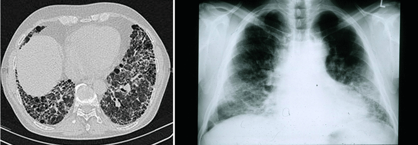 Wann sollte bei der idiopathischen Lungenfibrose mit der Therapie begonnen werden?