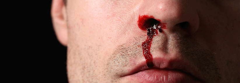 Wie gefährlich eine Blutung unter oraler Antikoagulation ist, hängt unter anderem vom Ort der Blutung ab.