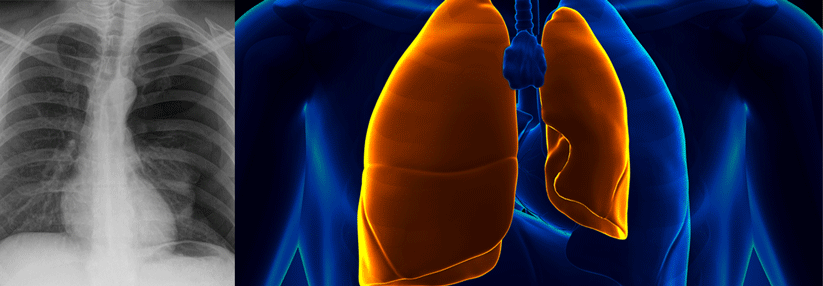 Für Diagnostik und Therapie des Patienten ist es entscheidend zu wissen, ob ein primärer oder sekundärer Pneumothorax vorliegt.