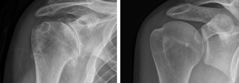 Diese Schulter (links) weist im Vergleich zu einer gesunden Schulter (rechts) typische Arthrosezeichen auf: Gelenkspaltverschmälerung, subchondrale Sklerosierungen und osteophytäre Anbauten.