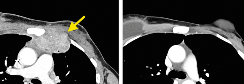 Im CT der Patientin sind die Filiae in der Brustwand (links) deutlich zu erkennen. 14 Monate nach der speziellen adoptiven Immuntherapie ist der CT-Befund unauffällig (rechts). 