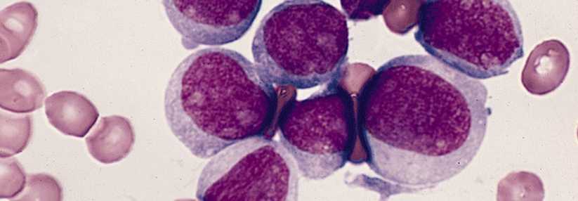 Der Inhibitor erweist sich bei Patienten mit rezidivierter oder refraktärer, IDH1-mutierter AML als gut verträglich.