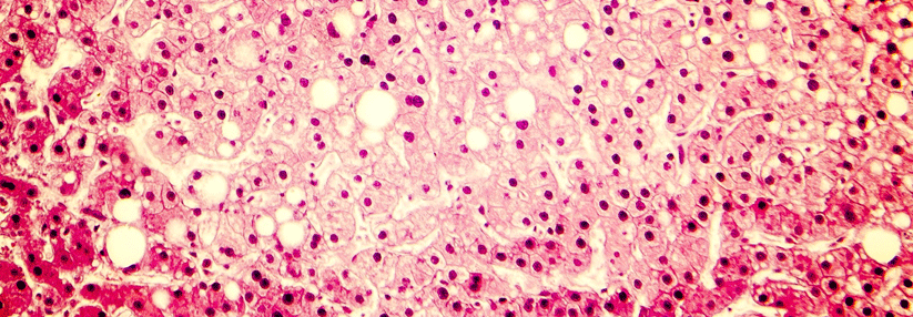 Per Biopsie lässt sich der Fibrosegrad am besten beurteilen. Andere Verfahren eignen sich aber, fortgeschrittene Stadien mit hoher Wahrscheinlichkeit auszuschließen.