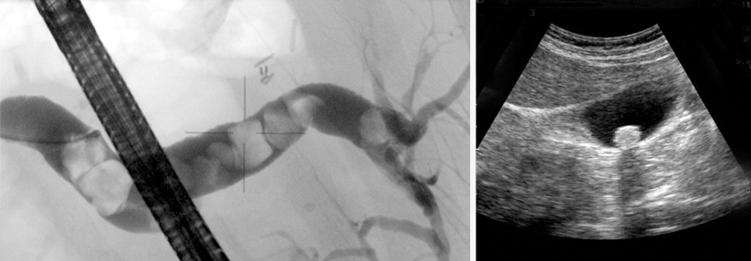 Sprechen Sono und Labor stark für eine Choledocholithiasis, geht‘s direkt zur endoskopisch retrograden Cholangio­graphie (links). Und findet sich in der Gallenblase ein großer Stein, kommt man um eine OP nicht herum (rechts).