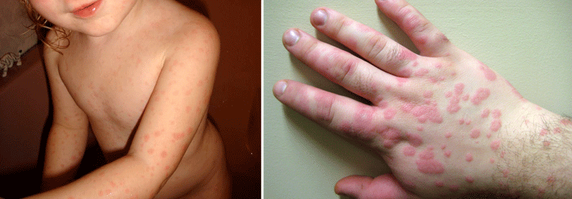 Mykoplasmen: Pneumonie-Erreger zerfressen die Schleimhaut Die Veränderungen an den Schleimhäuten aufgrund der Mykoplasmen haben starke Ähnlichkeit mit den Läsionen einer Erythema multiforme.