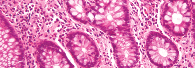 Individualisierte Therapieregime ermöglichen bald passgenaue und zielgerichtete Behandlungserfolge bei der immunologischen Beeinflussung chronisch-entzündlicher Darmerkrankungen.