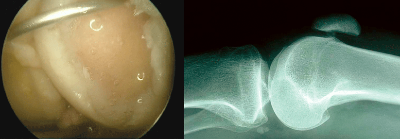 Bei Knieschmerzen kommen viele Ursachen infrage - beispielsweise eine „Gelenkmaus“ (links) oder ein patellofemorales Schmerzsyndrom (rechts).