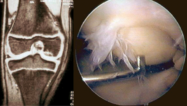 Knieschmerzen – Woran liegt's? Bei der Osteochondrosis dissecans ermöglicht die MRT (links) die exakte Lokalisation, Verlaufskontrolle und Einschätzung der Vitalität. Eine genauere Beurteilung gelingt mittels Arthroskopie (rechts).