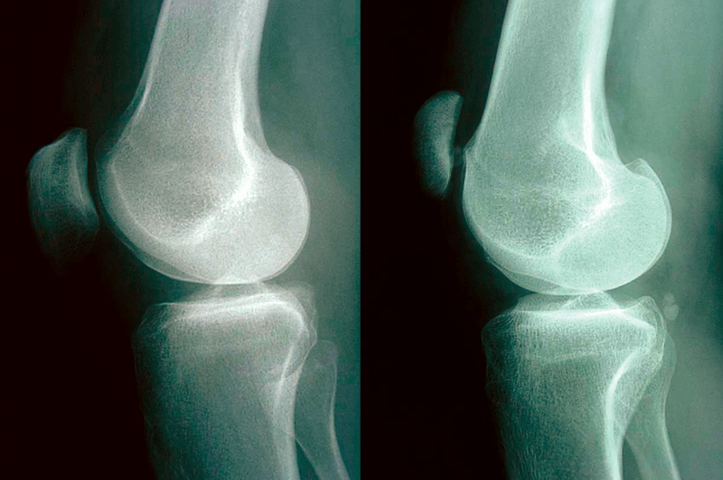 Patellofemorales Schmerzsyndrom mit Trochleadysplasie (Crossing sign, rechts). Zum Vergleich: eine normale Trochlea (links).